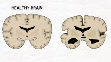 2-Minute Neuroscience: Alzheimer's Disease