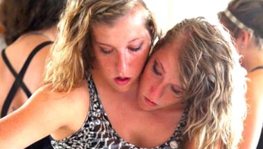 Incredible Conjoined Twins