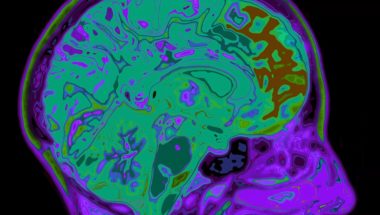 Could virus-like proteins be causing Alzheimer's?