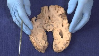Neuroanatomy Video Lab - Brain Dissections: Basal Ganglia
