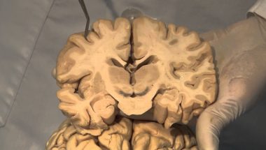 Neuroanatomy Video Lab - Brain Dissections: Cortical Localization