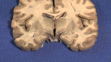 Neuroanatomy Video Lab - Brain Dissections: Hypothalamus