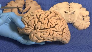 Neuroanatomy Video Lab - Brain Dissections: Limbic