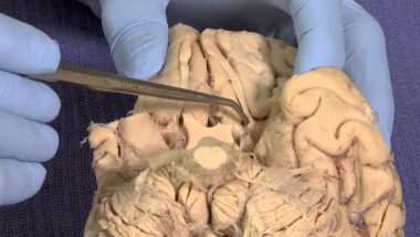 Neuroanatomy Video Lab - Brain Dissections: Olfactory