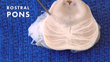 Neuroanatomy Video Lab - Brain Dissections: Sensation from the Body
