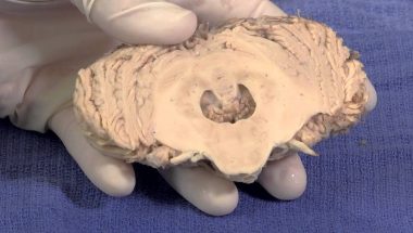 Neuroanatomy Video Lab - Brain Dissections: The Cerebellum