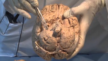 Neuroanatomy Video Lab - Brain Dissections: The Meninges