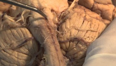 Neuroanatomy Video Lab - Brain Dissections: The Most Important Pathway - Motor Control