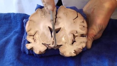 Neuroanatomy Video Lab - Brain Dissections: The Visual Pathway