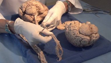 Neuroanatomy Video Lab - Brain Dissections: Three Critical Vertical Pathways