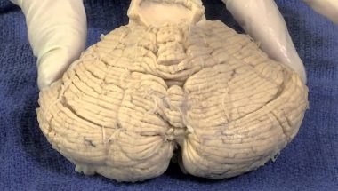 Neuroanatomy Video Lab - Brain Dissections: Vestibular System