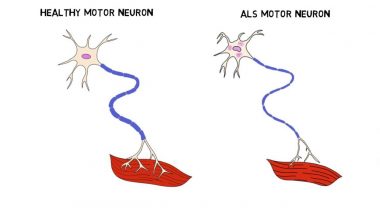 2-Minute Neuroscience: Amyotrophic Lateral Sclerosis (ALS)