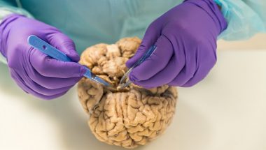The Man Slicing Up Brains for Parkinson’s Research