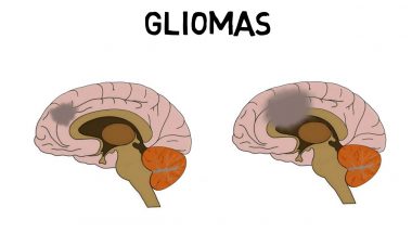 2-Minute Neuroscience: Brain tumors